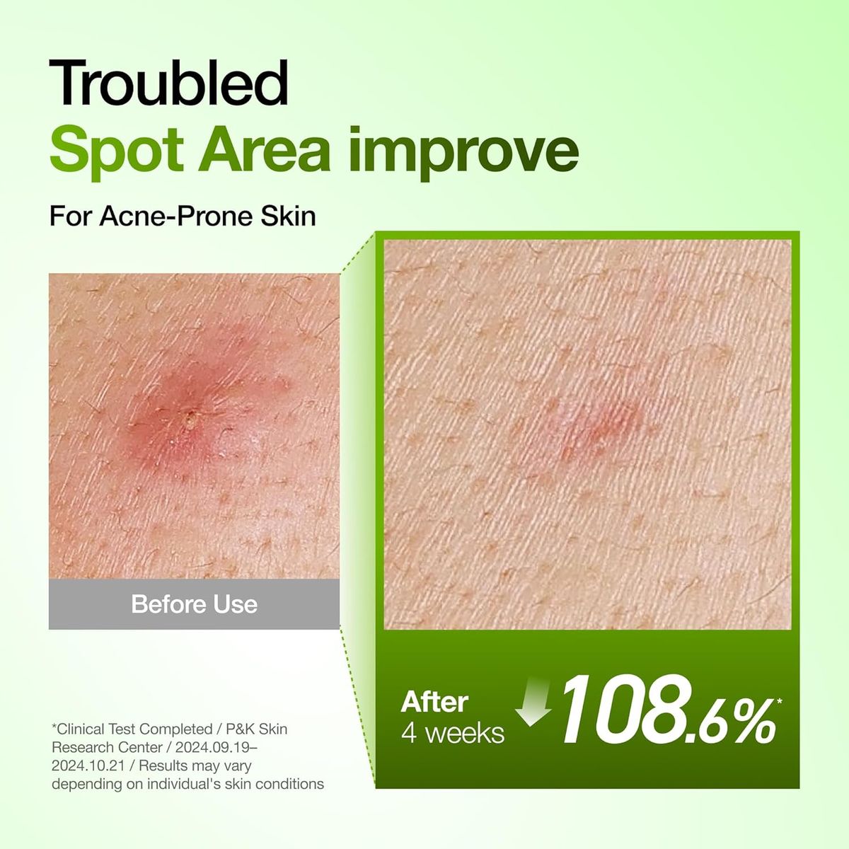 Anua Azelaic Acid 10 Hyaluron Serum: Redness Soothing