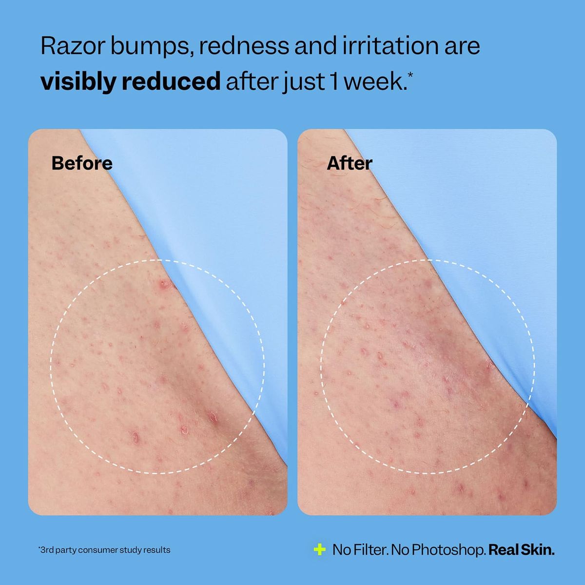 Get Silky Skin: Peach & Lily Peach Slices Ingrown Hair Treatment